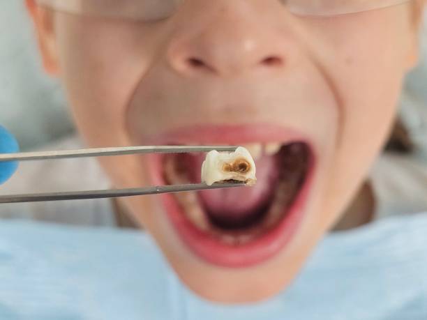 Best Emergency Tooth Extraction  in Keene, TX